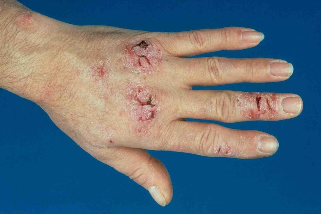Hand- en voeteczeem