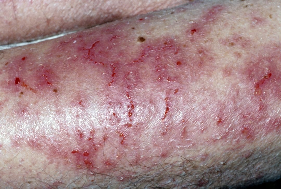 Psoriasis capitis