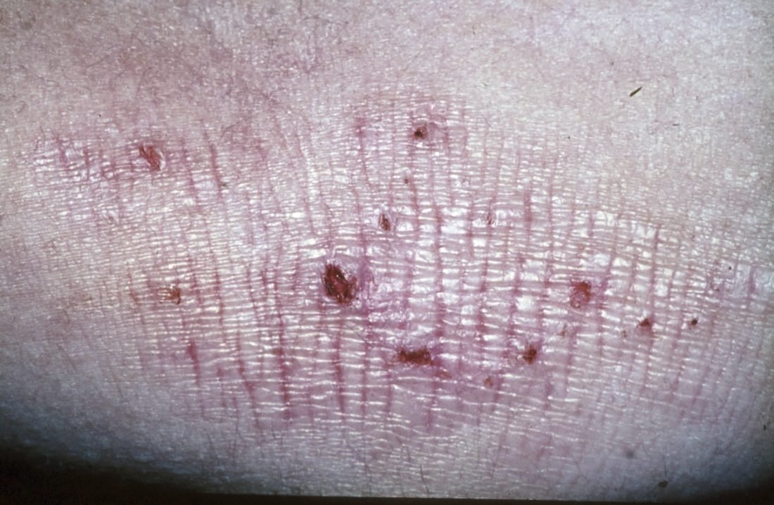 Nagelpsoriasis