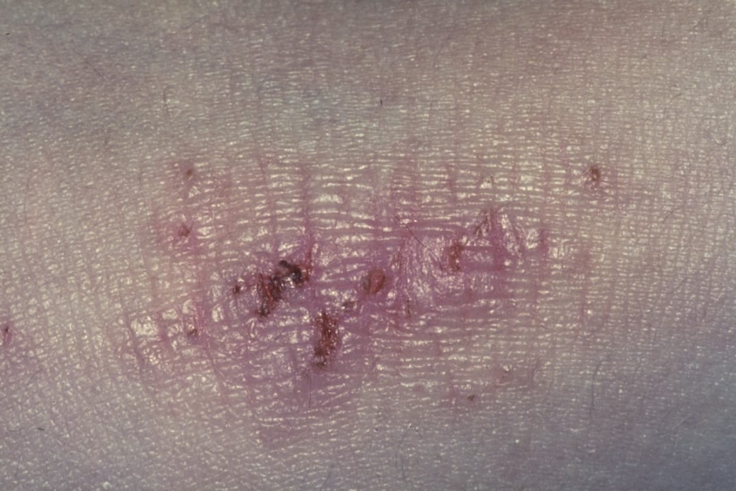 Palmoplantaire psoriasis