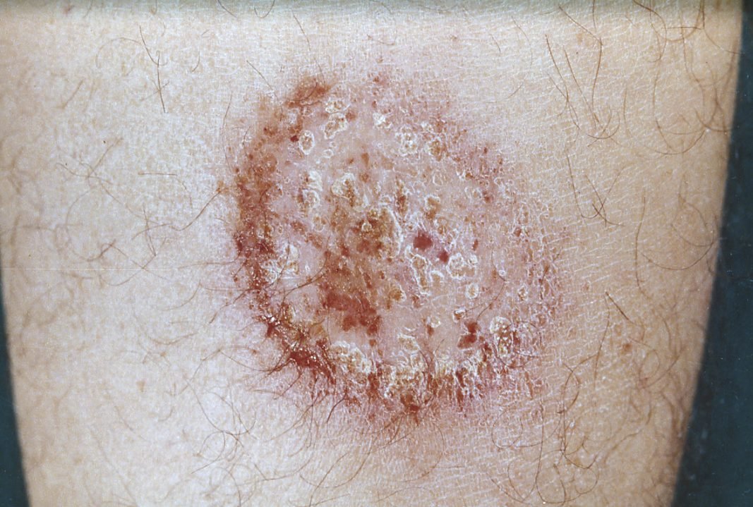 Psoriasis vulgaris